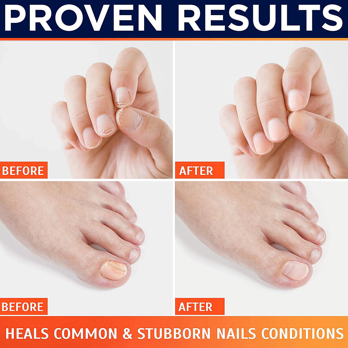 Effective Nail Fungus Removal Laser Treatment Device