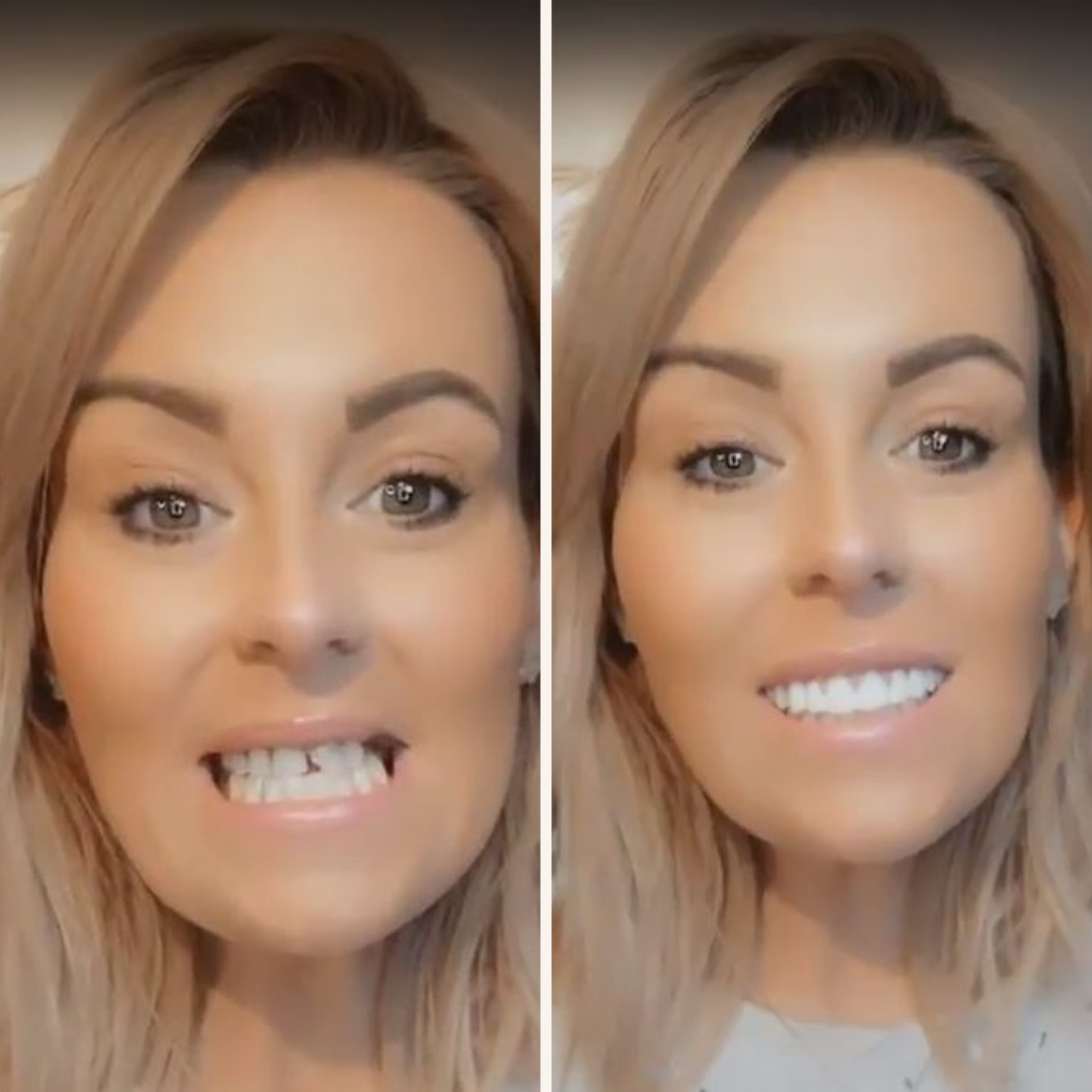 At Home Teeth Veneer Kit Easy Smile Makeover