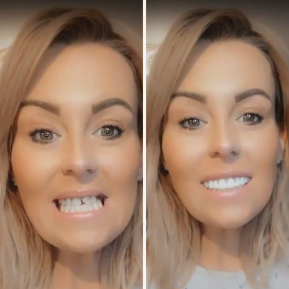 At Home Teeth Veneer Kit Easy Smile Makeover