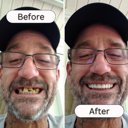 At Home Teeth Veneer Kit Easy Smile Makeover