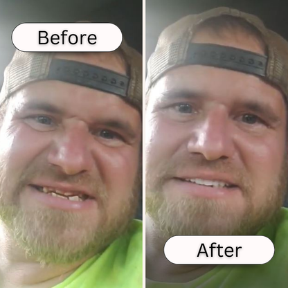 At Home Teeth Veneer Kit Easy Smile Makeover