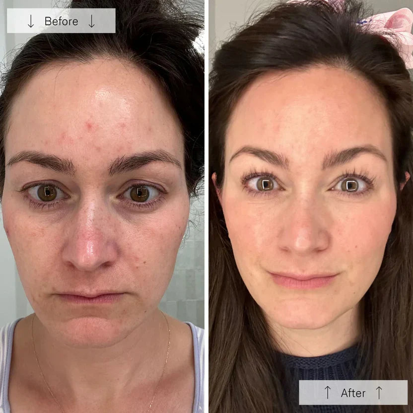 Advanced LED Face Mask for Skin Renewal