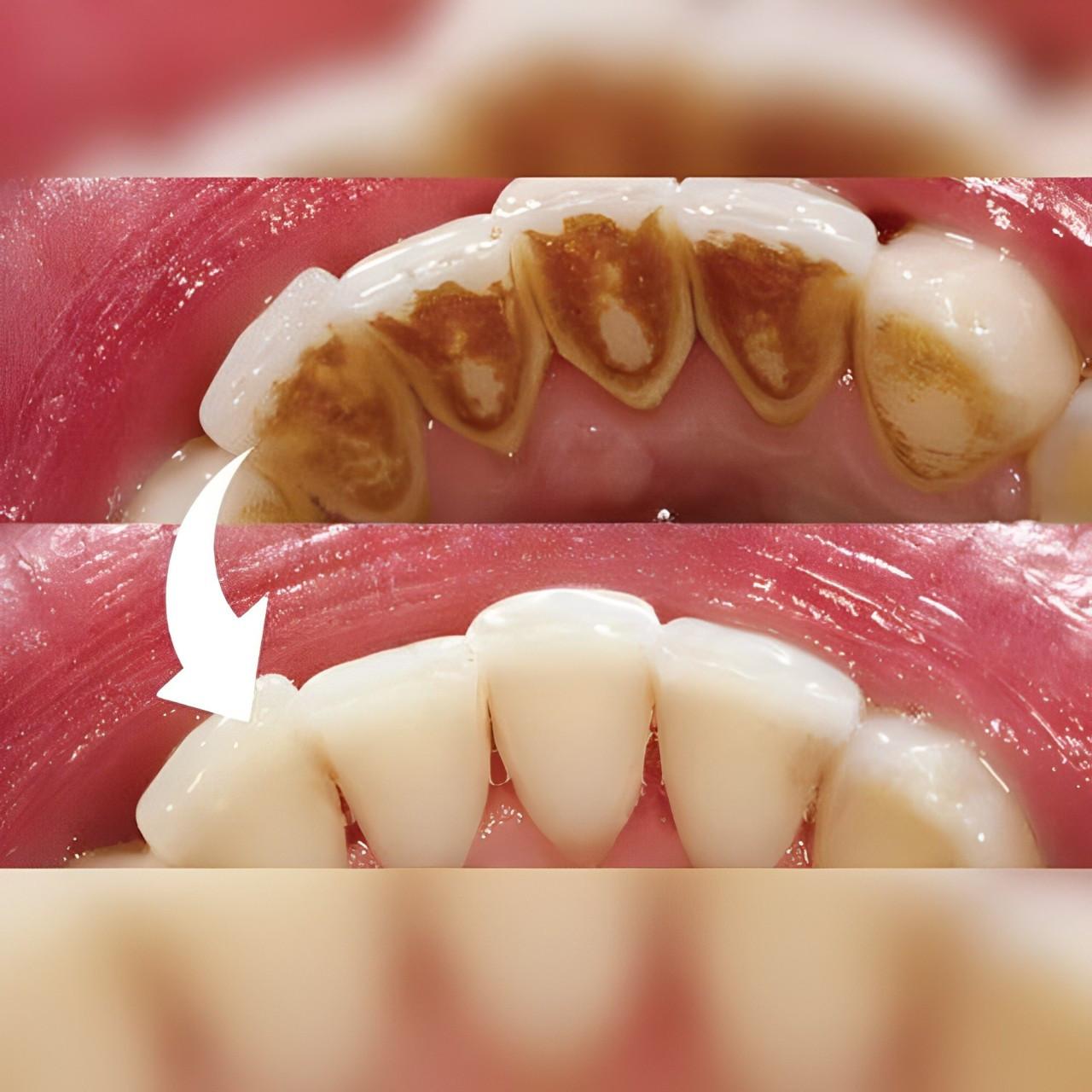 Advanced Oral Care Plaque Remover