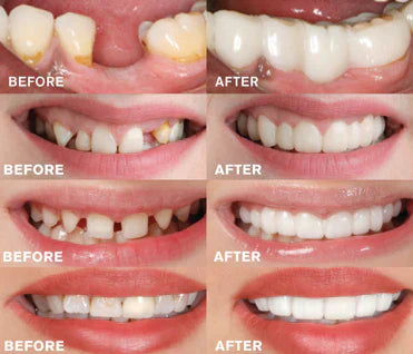 Comfort Fit Snap Denture