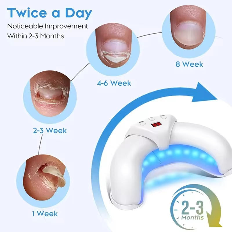 Effective Toenail Fungus Treatment Laser