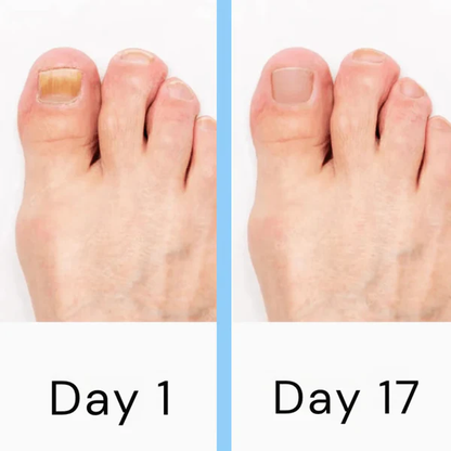 Easy Home Nail Fungus Laser Treatment