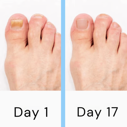 Advanced Toenail Fungus Removal Tool
