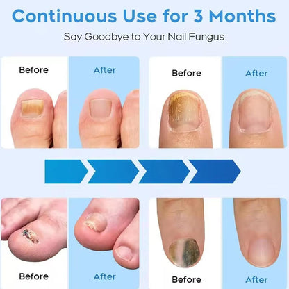 Effective Toenail Fungus Treatment Laser