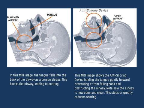 Sleep Aid Anti Snore Device for Easy Breathing