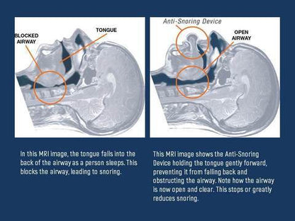 Sleep Aid Anti Snore Device for Easy Breathing