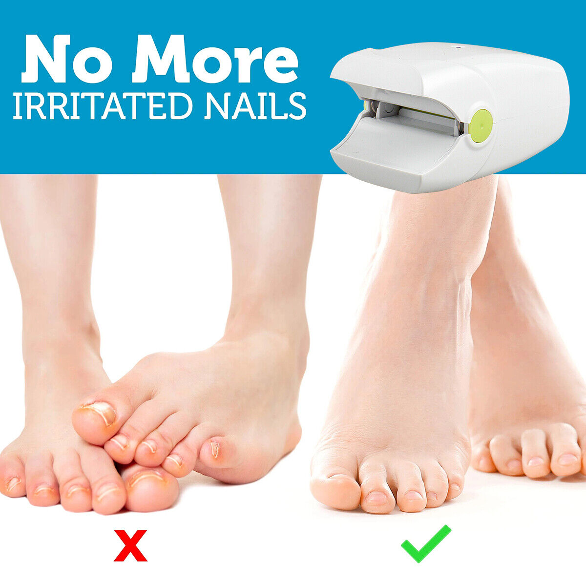 Effective Nail Fungus Removal Laser Treatment Device
