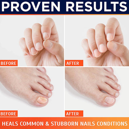 Effective Nail Fungus Removal Laser Treatment Device